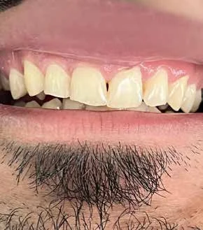 کامپوزیت لبه شفاف و اصلاح فرم