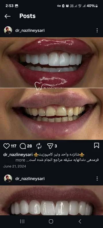 طراحی لبخند طبیعی