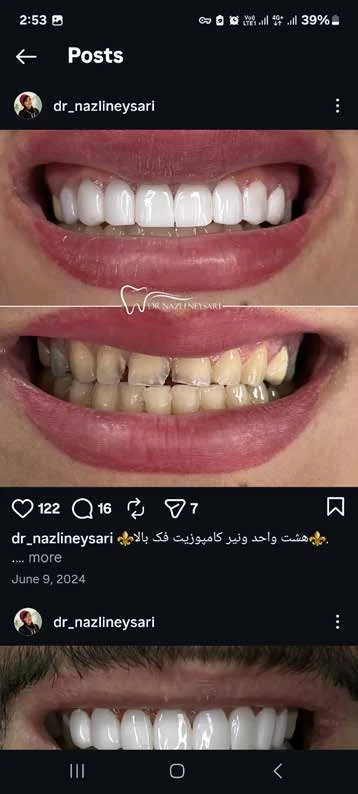 اصلاح فاصله دندان‌ها