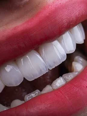 کامپوزیت لیرینگ و طراحی لبخند طبیعی
