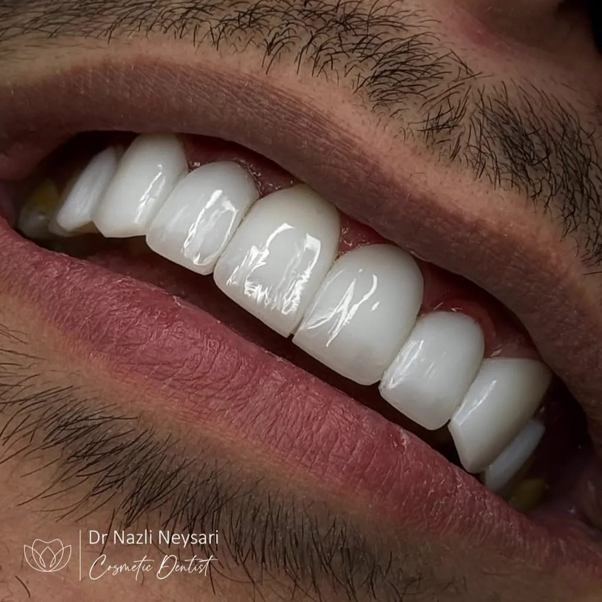 نمونه طراحی لبخند متناسب با چهره